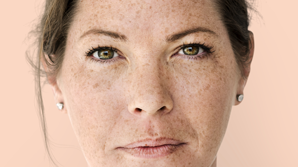 melasma